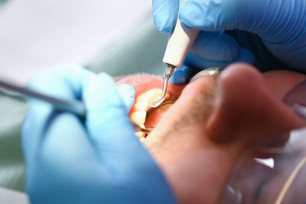 Best Emergency Root Canal Treatment in Lexington, NC